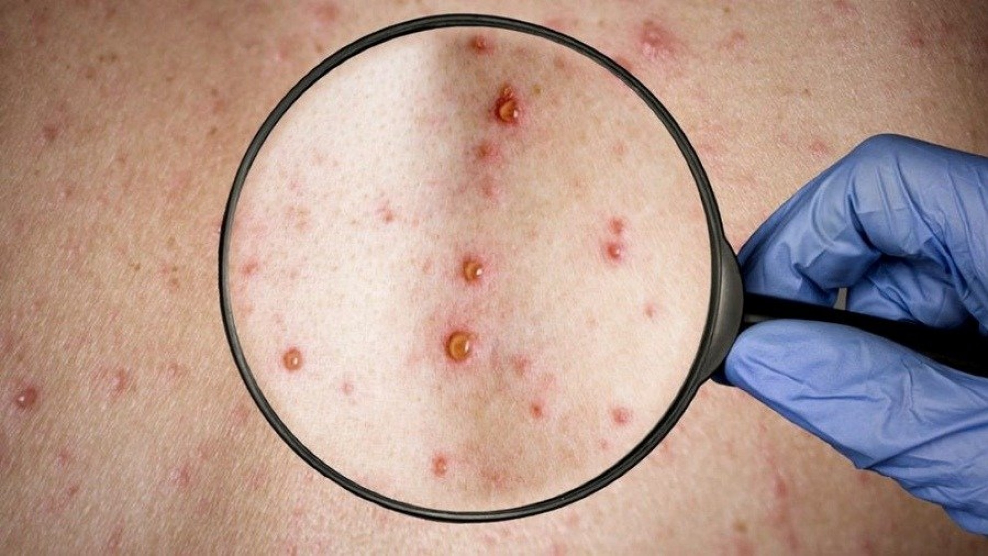 Nuevo caso de viruela del mono detectan en el país